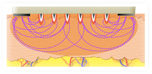 Fractora