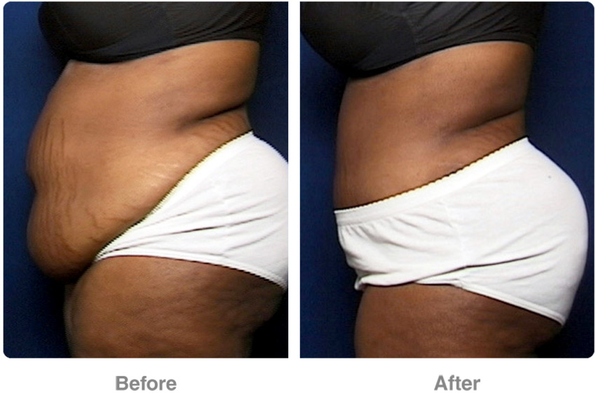 Abdominoplasty - How Much For A Tummy Tuck | How To Online Database