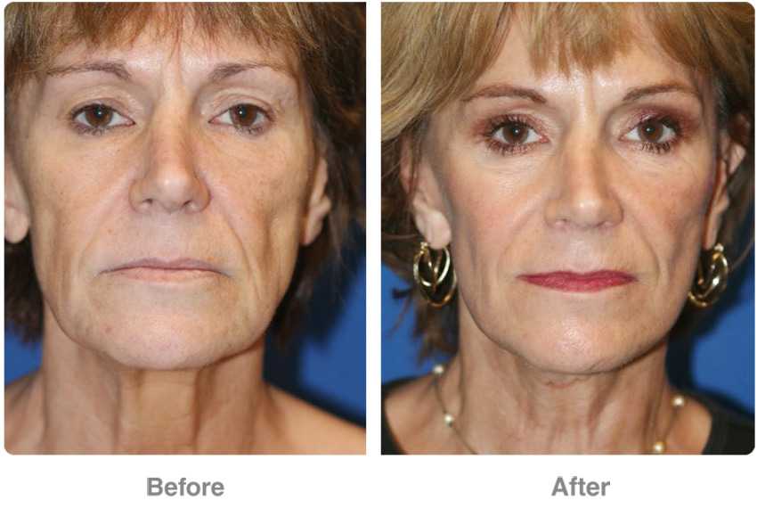 Facelift & Mid-Face Lift by Quadrupled Certified Surgeon Dr Troell