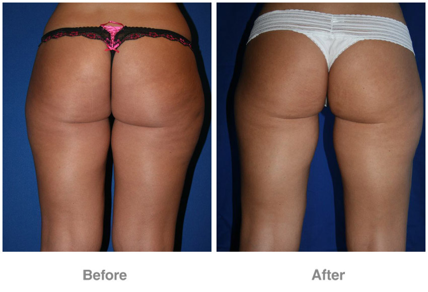 brazilian butt-lift before and after brazilian butt-lift before and after