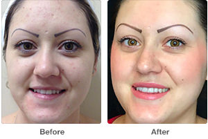 Before and After Hydrafacials Photos