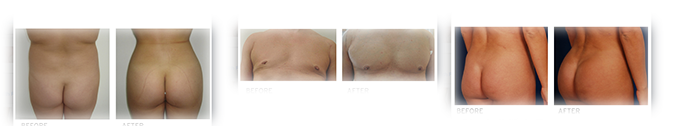 Vaser Lipo with Fat Graphing Results