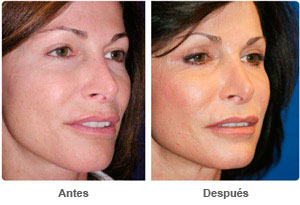 Before and After Laser Skin Therapy