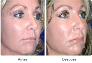 Before and After Lip Augmentation