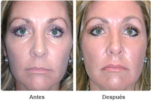 Before and After Lip Augmentation