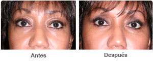 Before and After Cosmetic Eyelid Surgery