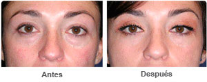 Before and After Cosmetic Eyelid Surgery