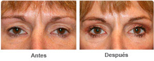 Before and After Cosmetic Eyelid Surgery