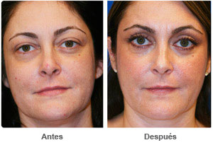 Before and After Cosmetic Eyelid Surgery