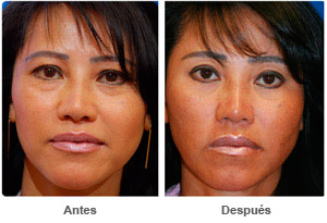 Before and After Cosmetic Eyelid Surgery