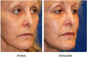 Before and After Liposuction