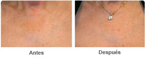 Before and After Laser Skin Therapy