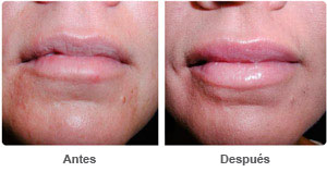 Before and After Lip Augmentation