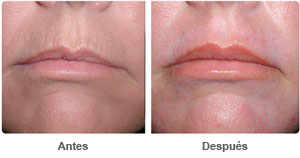 Before and After Lip Augmentation