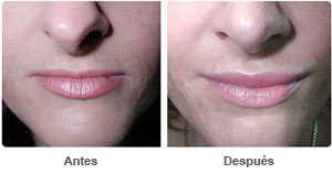 Before and After Lip Augmentation
