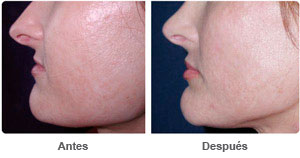 Before and After Lip Augmentation