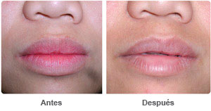 Before and After Lip Reduction