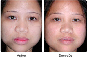 Before and After Lip Reduction