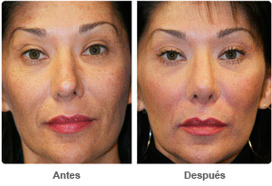 Before and After Rhinoplasty