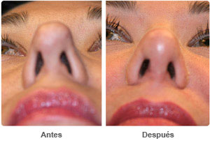 Before and After Rhinoplasty