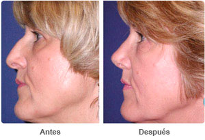 Before and After Rhinoplasty
