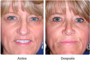 Before and After Rhinoplasty