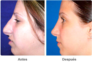 Before and After Rhinoplasty