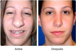 Before and After Rhinoplasty