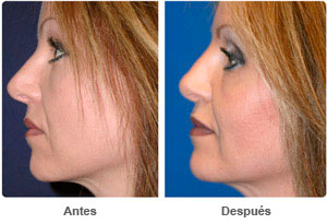 Before and After Rhinoplasty