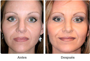 Before and After Rhinoplasty