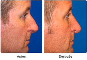 Before and After Rhinoplasty