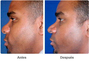 Before and After Rhinoplasty