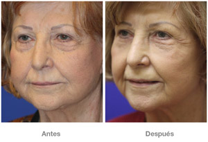 Before and After Laser Skin Therapy
