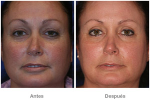 Before and After Cosmetic Eyelid Surgery