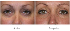 Before and After Cosmetic Eyelid Surgery