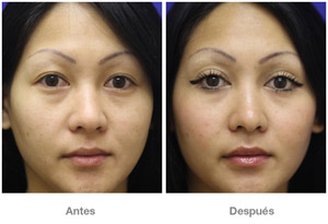 Before and After Cosmetic Eyelid Surgery