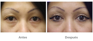 Before and After Cosmetic Eyelid Surgery