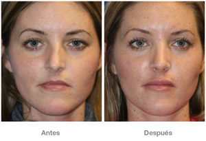 Before and After Lip Augmentation
