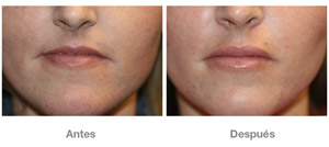 Before and After Lip Augmentation