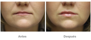 Before and After Lip Augmentation