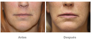 Before and After Lip Augmentation