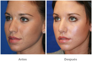 Before and After Rhinoplasty