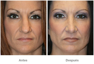 Before and After Rhinoplasty