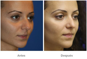 Before and After Rhinoplasty