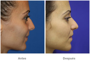 Before and After Rhinoplasty