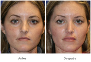 Before and After Rhinoplasty