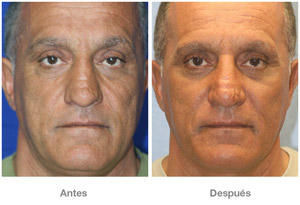 Before and After Rhinoplasty