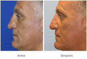 Before and After Rhinoplasty