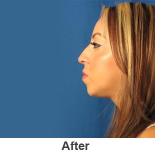 Chin Implants - After - Patient 1a