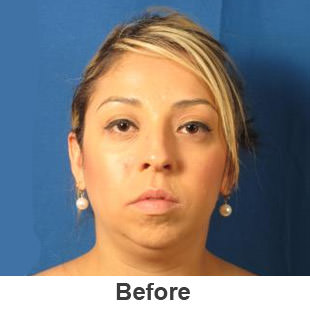 Chin Implants - Before - Patient 1a